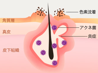 跡になってしまう肌のメカニズムの図