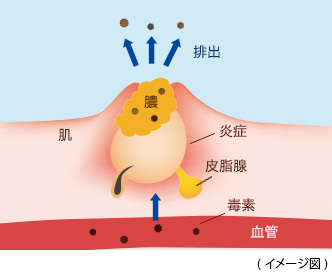 毒素によってニキビができるメカニズムを図解したイラスト：毒素、血管、膿、炎症、排出、皮脂腺、肌、ニキビ