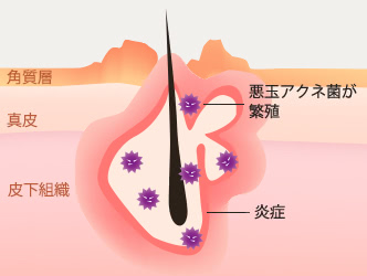 思春期ニキビができるメカニズムの図