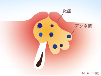 赤ニキビ（赤色丘疹（せきしょくきゅうしん））