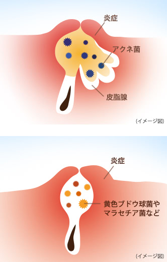 急 に 吹き出物