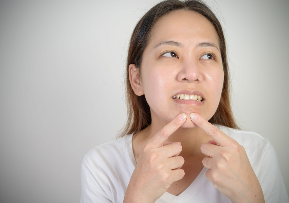 顎まわりニキビの原因は? 顎下にできやすいのはなぜ?