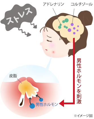 過度のストレスが顎ニキビを引き起こすメカニズムの図：ストレス、アドレナリン、コルチゾール、男性ホルモンを刺激、男性ホルモン、皮脂