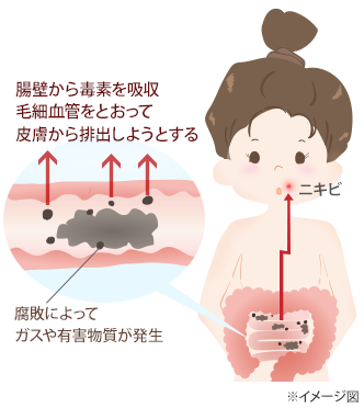 便秘がニキビを引き起こすメカニズムの図：腸壁から毒素を吸収毛細血管をとおって皮膚から排出しようとする、腐敗によってガスや有害物質が発生