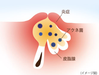 吹き出物ができる仕組みの図：【ニキビ】炎症　アクネ菌　皮脂腺