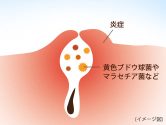 吹き出物ができる仕組みの図：【毛包炎】炎症　黄色ブドウ球菌やマラセチア菌など