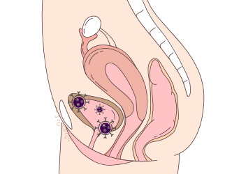 膀胱炎は、大腸菌などの細菌が尿道口から入り、膀胱で増殖して起こる病気