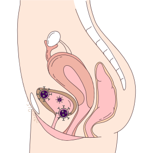 膀胱炎は、大腸菌などの細菌が尿道口から入り、膀胱で増殖して起こる病気