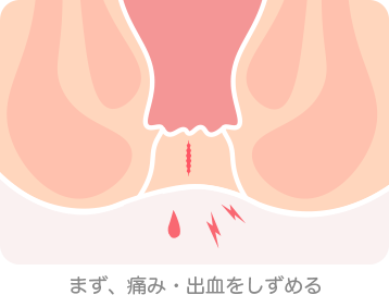 まず、痛み・出血をしずめる