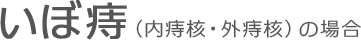 いぼ痔（内痔核・外痔核）の場合