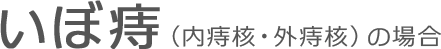 いぼ痔（内痔核・外痔核）の場合