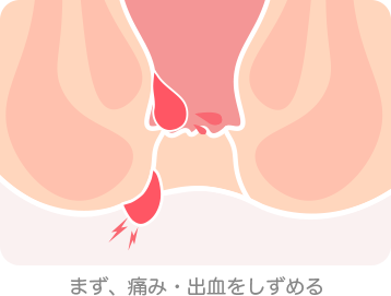 まず、痛み・出血をしずめる