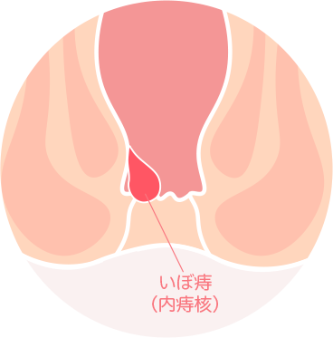 いぼ痔（内痔核）のイラスト