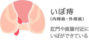 いぼ痔（内痔核・外痔核）：肛門や直腸付近にいぼができている