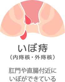 いぼ痔（内痔核・外痔核）：肛門や直腸付近にいぼができている