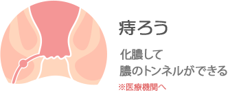 痔ろう：化膿して膿のトンネルができる※医療機関へ